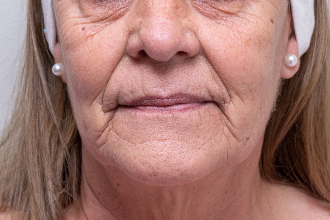 Antes Rejuvenecimiento facial con ácido hialurónico 1